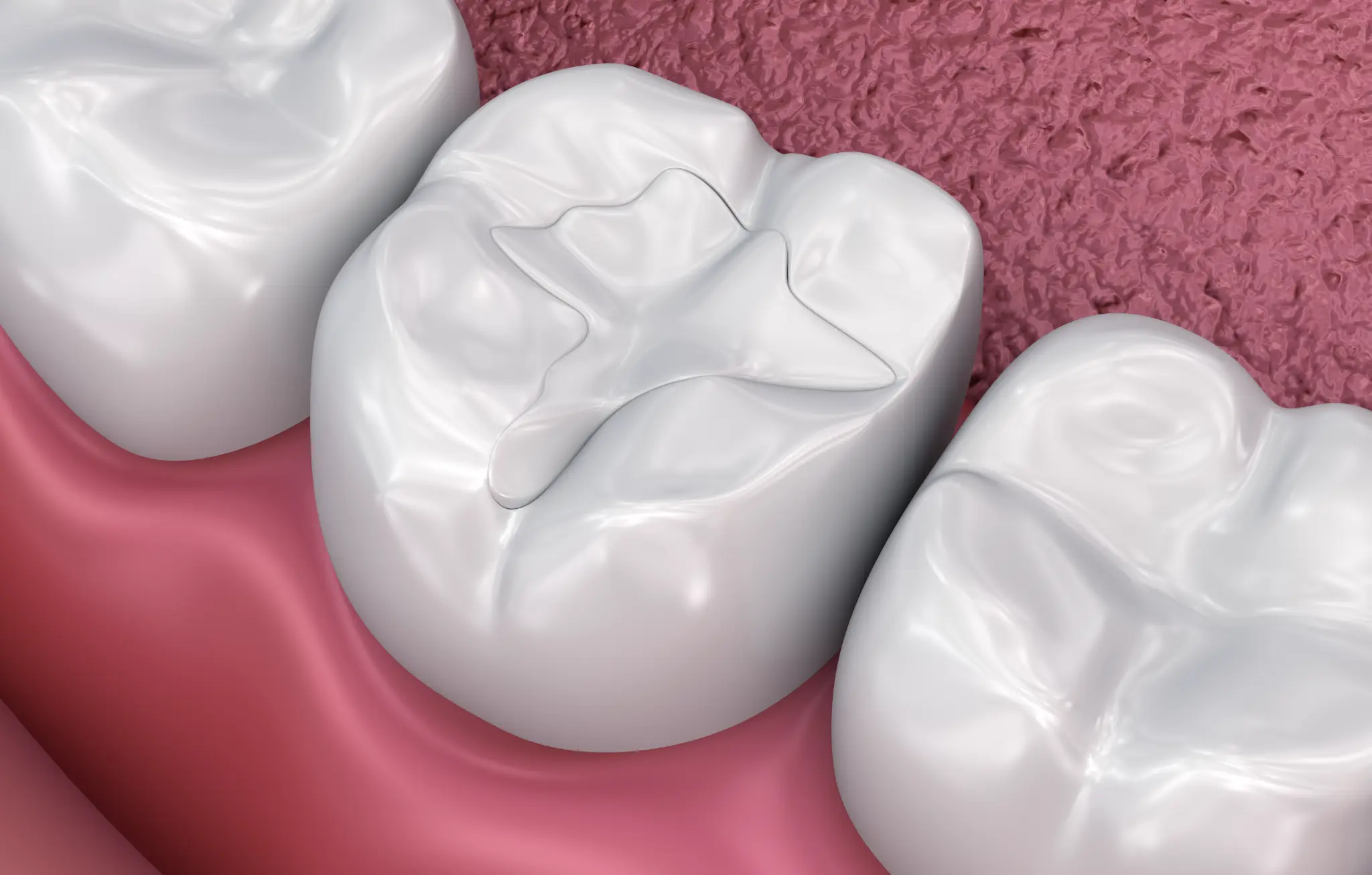 A composite filling restoring a tooth surface