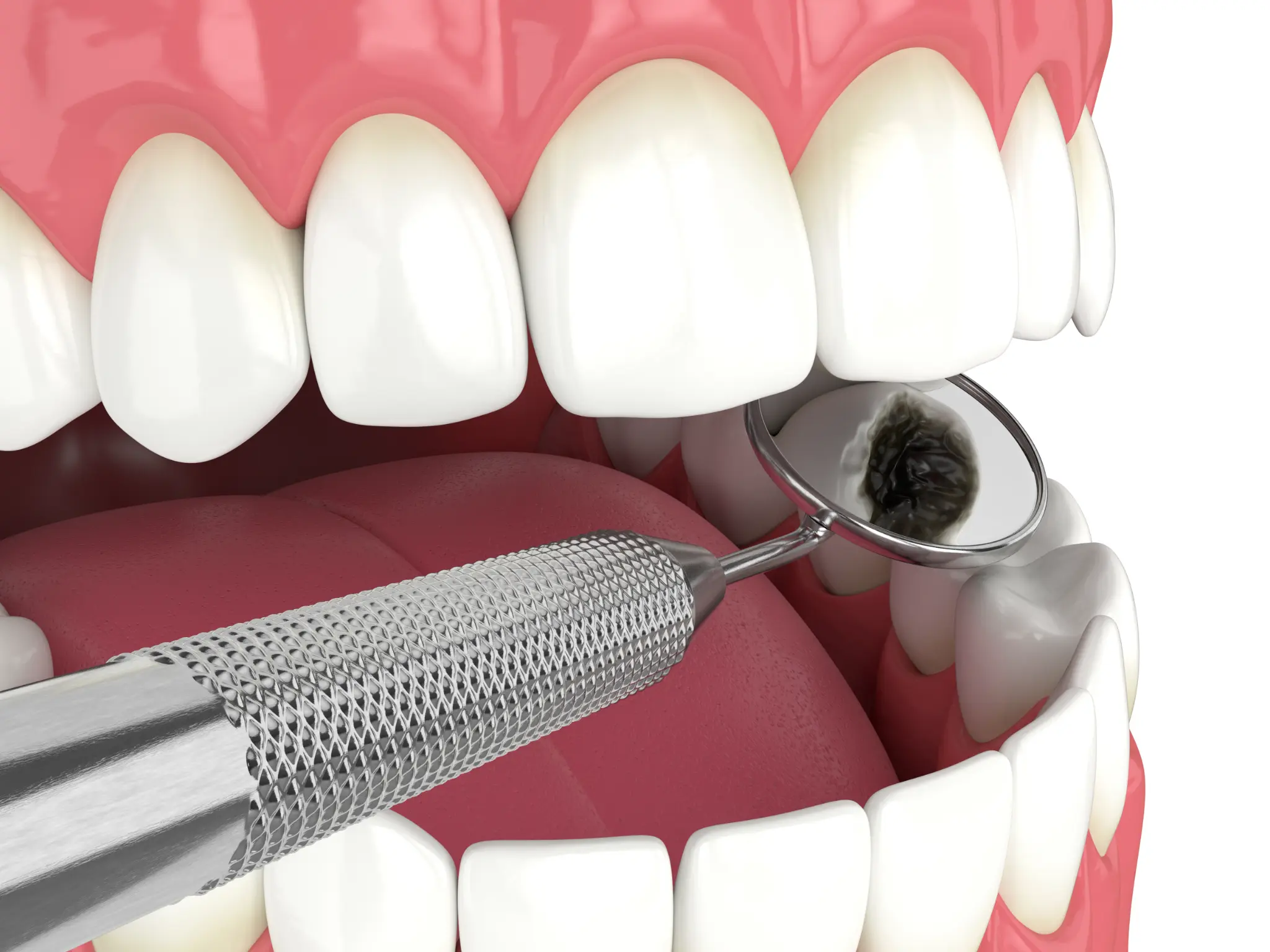 A close-up dental examination with a mirror and dental instrument
