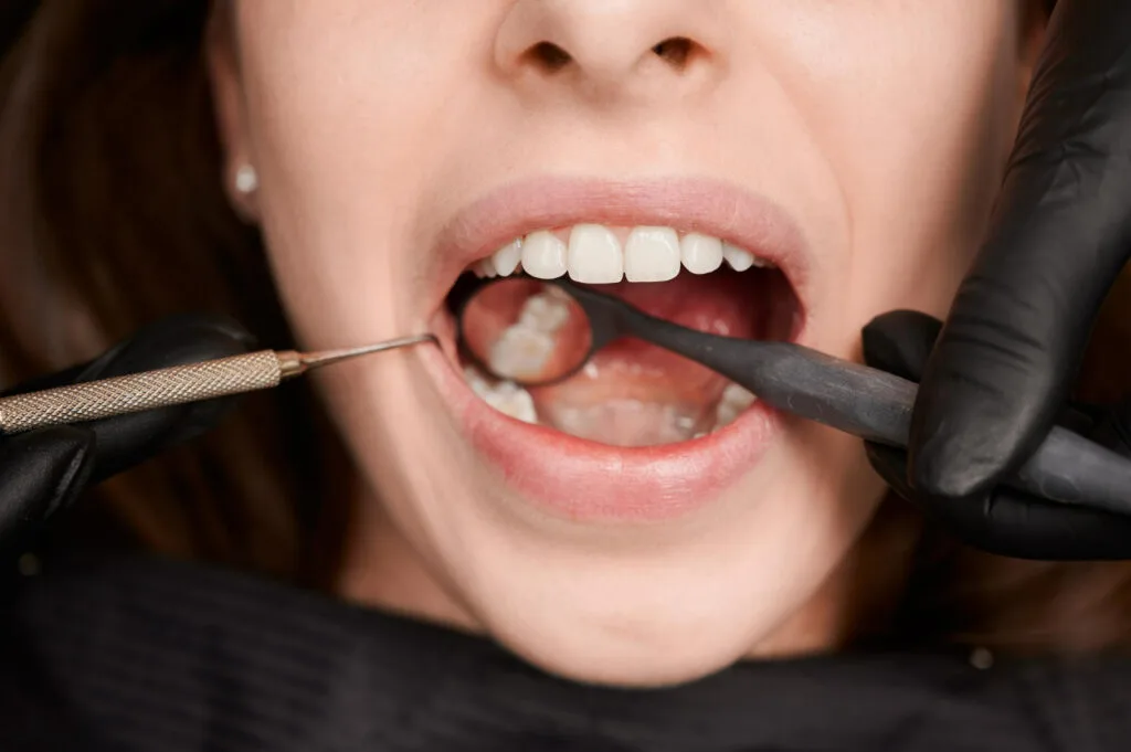 cavities