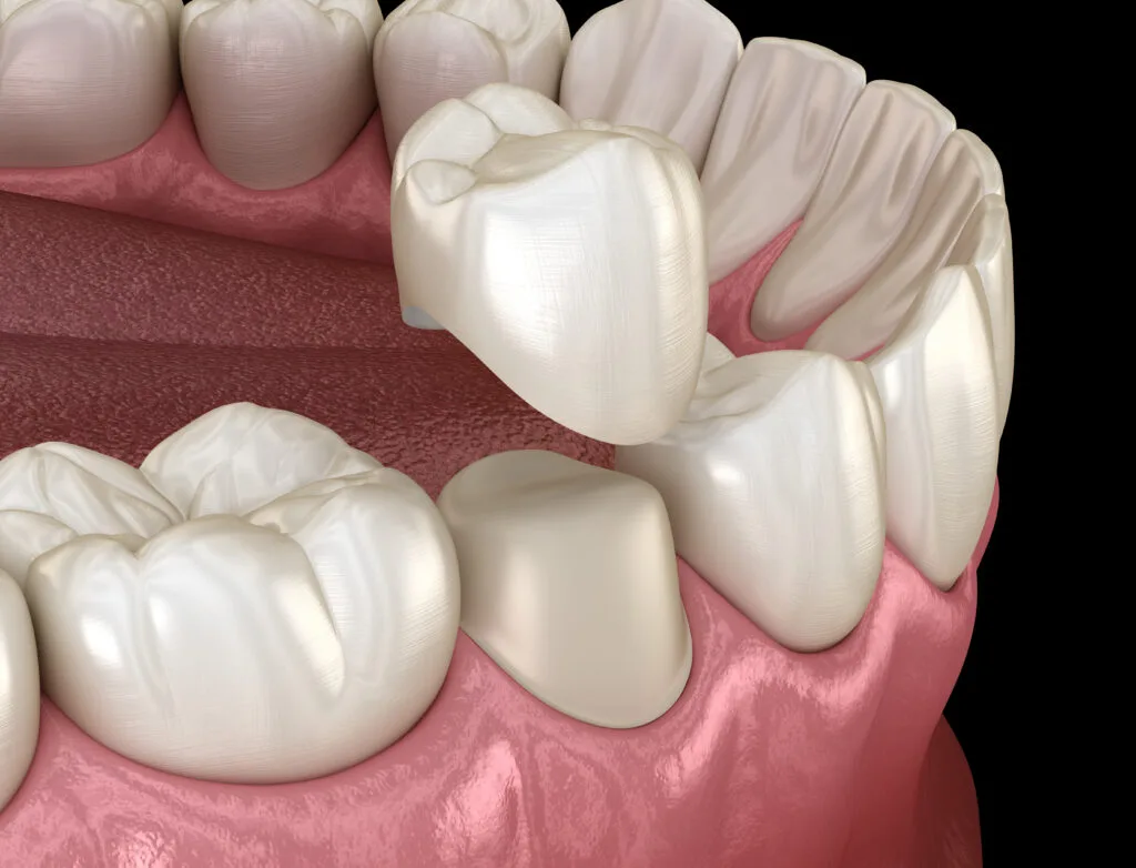 Dental-Crown-2-1-1024x782